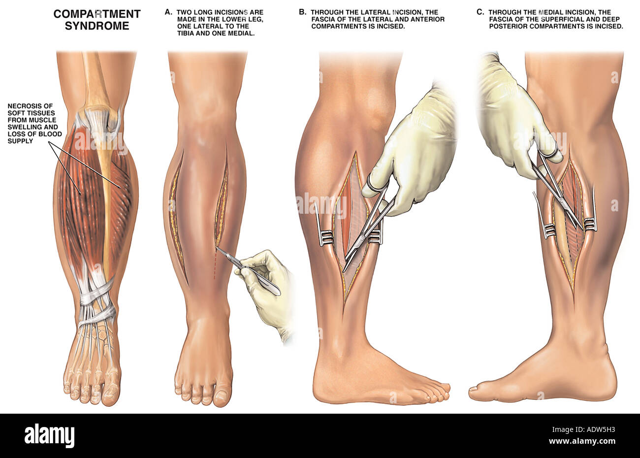 4 fach Fasziotomie Verfahren Stockfoto, Bild 7711954 Alamy