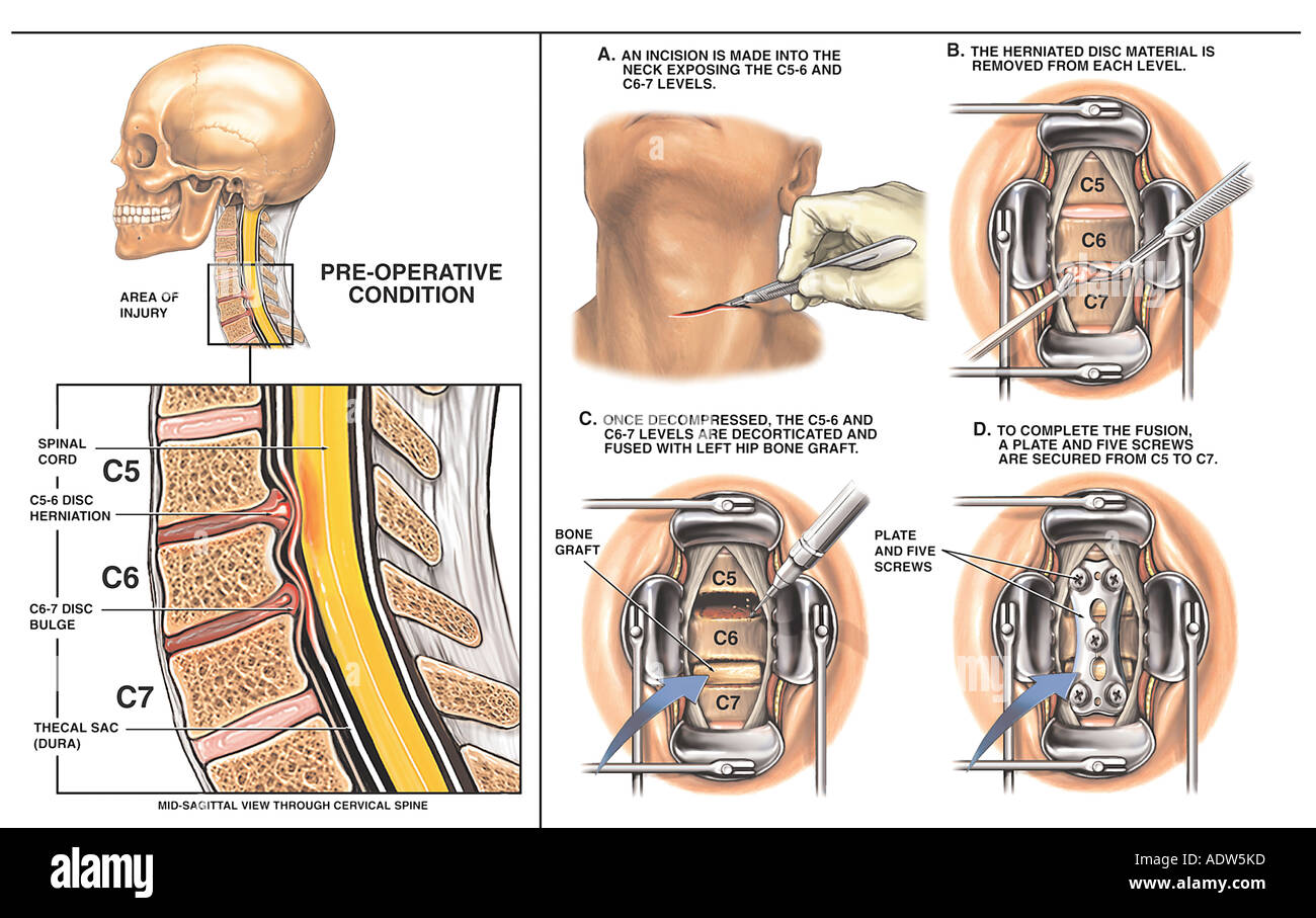 Wirbelsäule Operation C5 6 und C6 7 Disc Bandscheibenvorfälle mit zwei Level Diskektomie