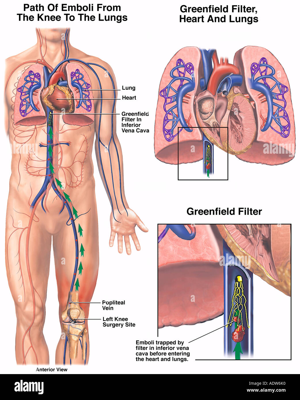 Vena cava filter -Fotos und -Bildmaterial in hoher Auflösung – Alamy