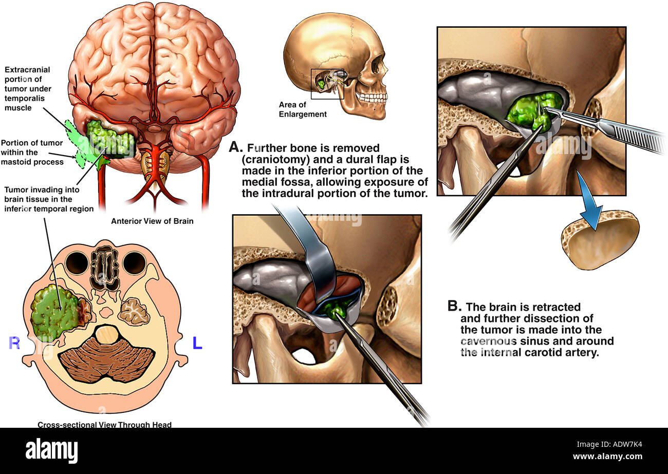 Bengn. Онкомаркеры ca cea. Развитие опухоли. Цитокин vegf. Tumor перевод.