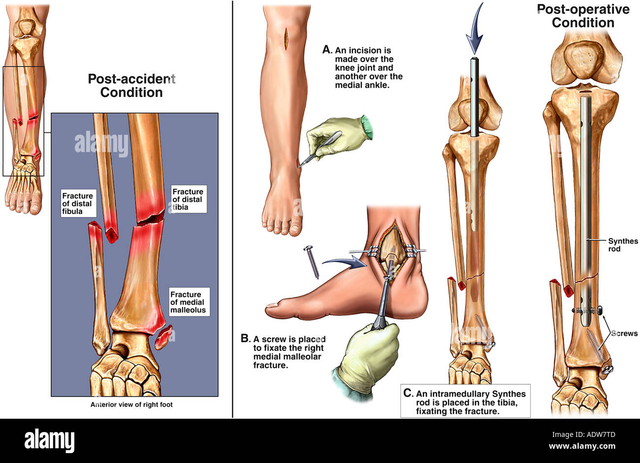 Richtige Sprunggelenksfrakturen mit chirurgische Fixierung