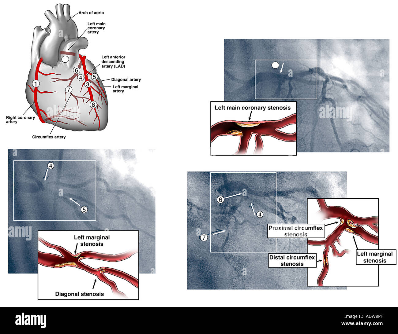 Stenotische arterien -Fotos und -Bildmaterial in hoher Auflösung – Alamy