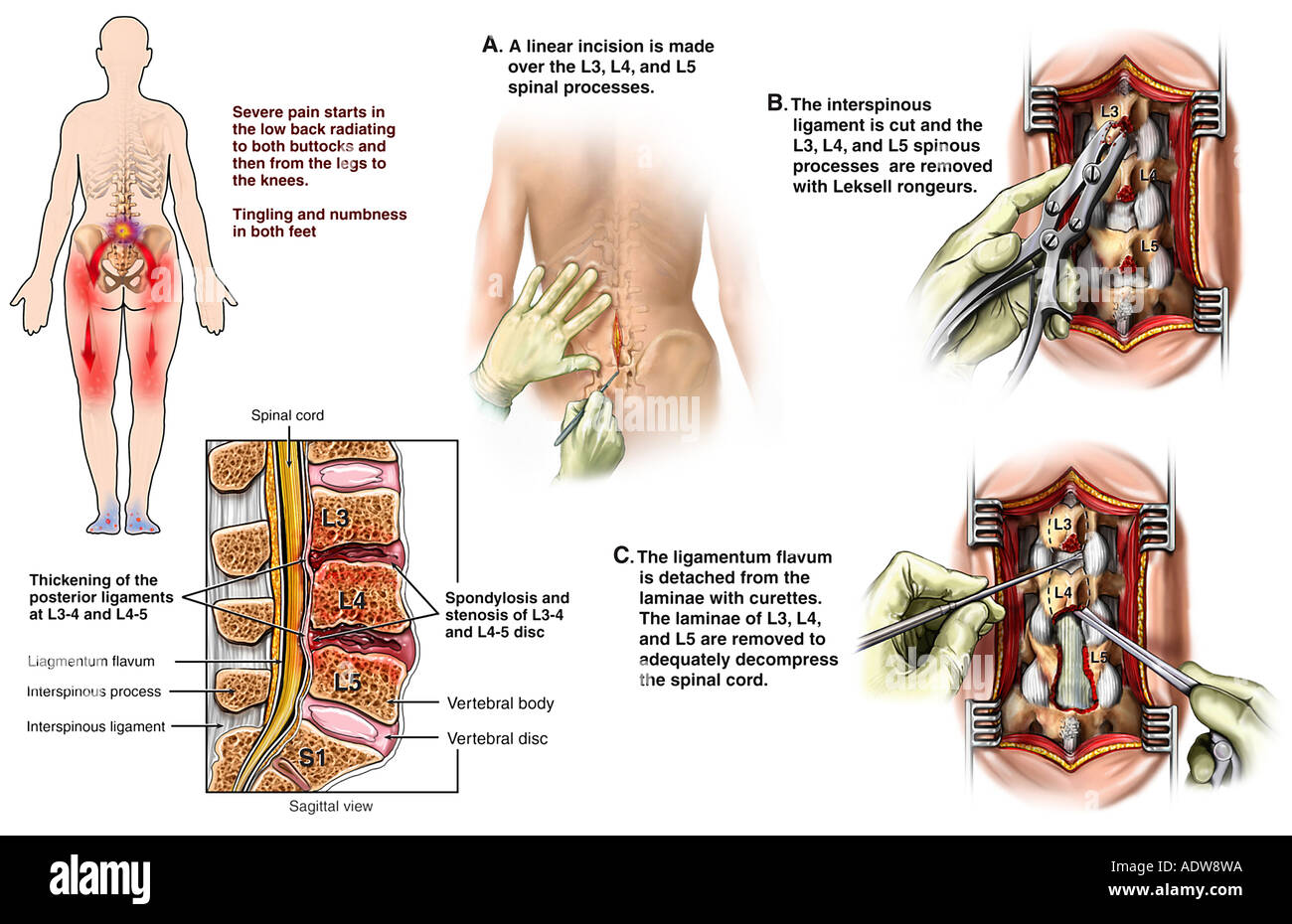 lumbale spinalkanalstenose operation