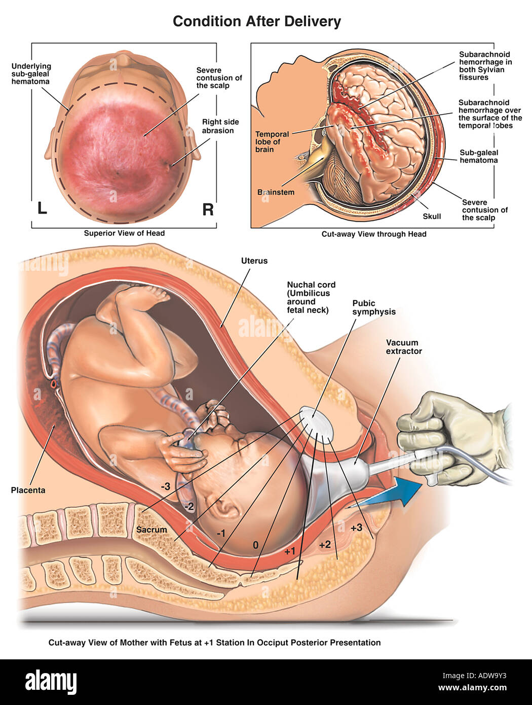 Вакуум экстракция плода. Оперативное родоразрешение классификация. Вакууэкстракция плода при беременности. Вакуумное извлечение плода. Вакуум экстрактор плода.
