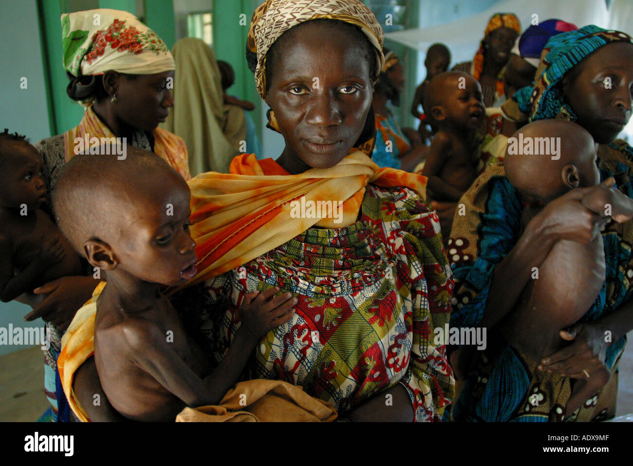 Im Norden von Nigeria ist hohes Maß an schwerer Unterernährung in der Bevölkerung Stockfoto