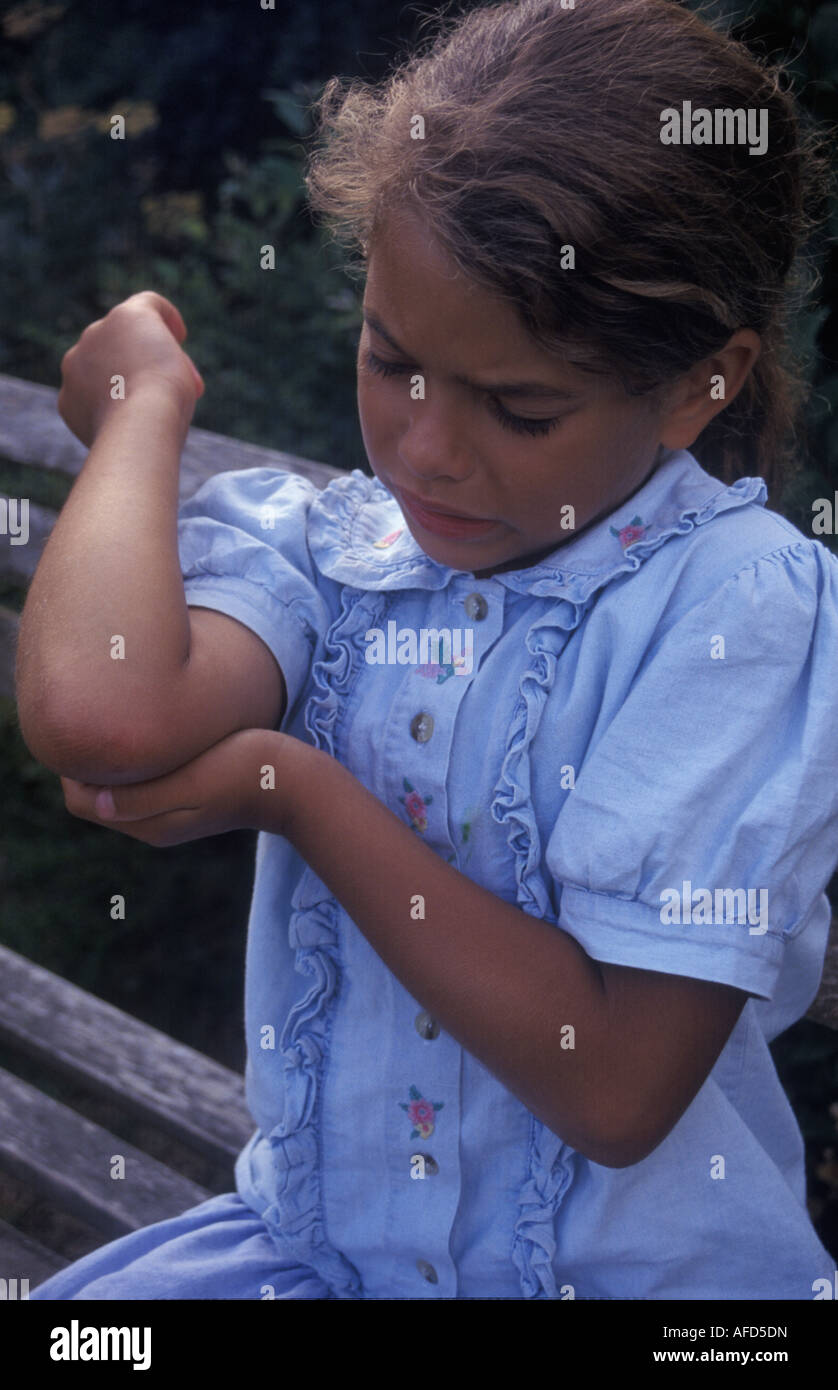 Mädchen mit Insektenstich auf ihrem Ellenbogen Stockfoto