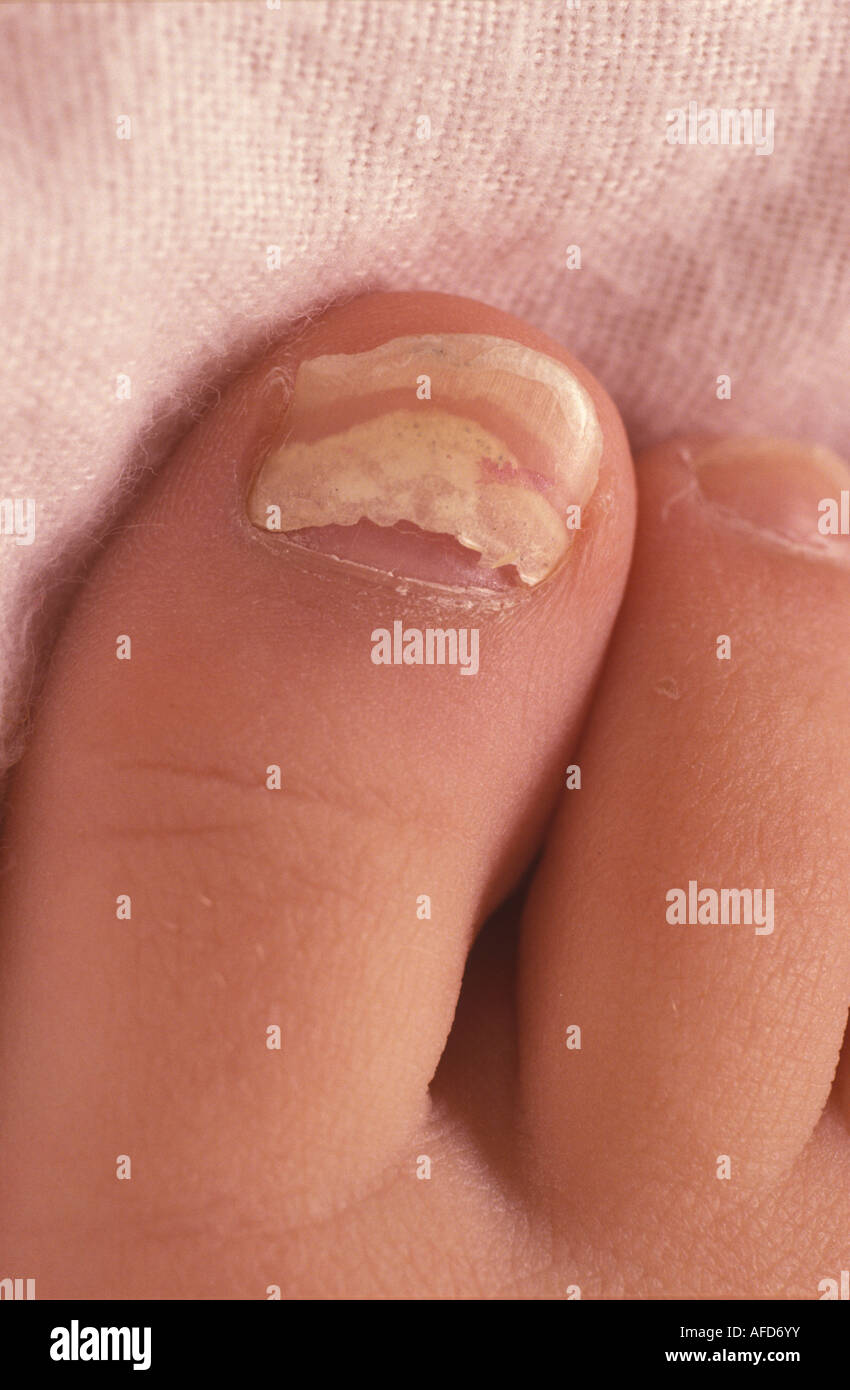 Detail eines gebrochenen Nagels Stockfoto