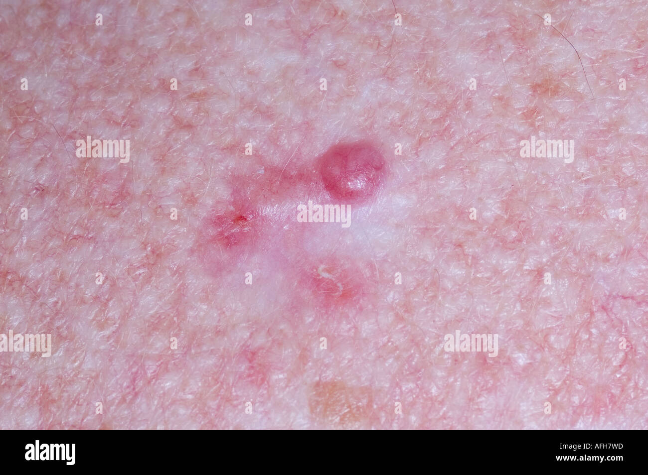 Wiederholung der knotige BCC oberen Rücken Stockfoto