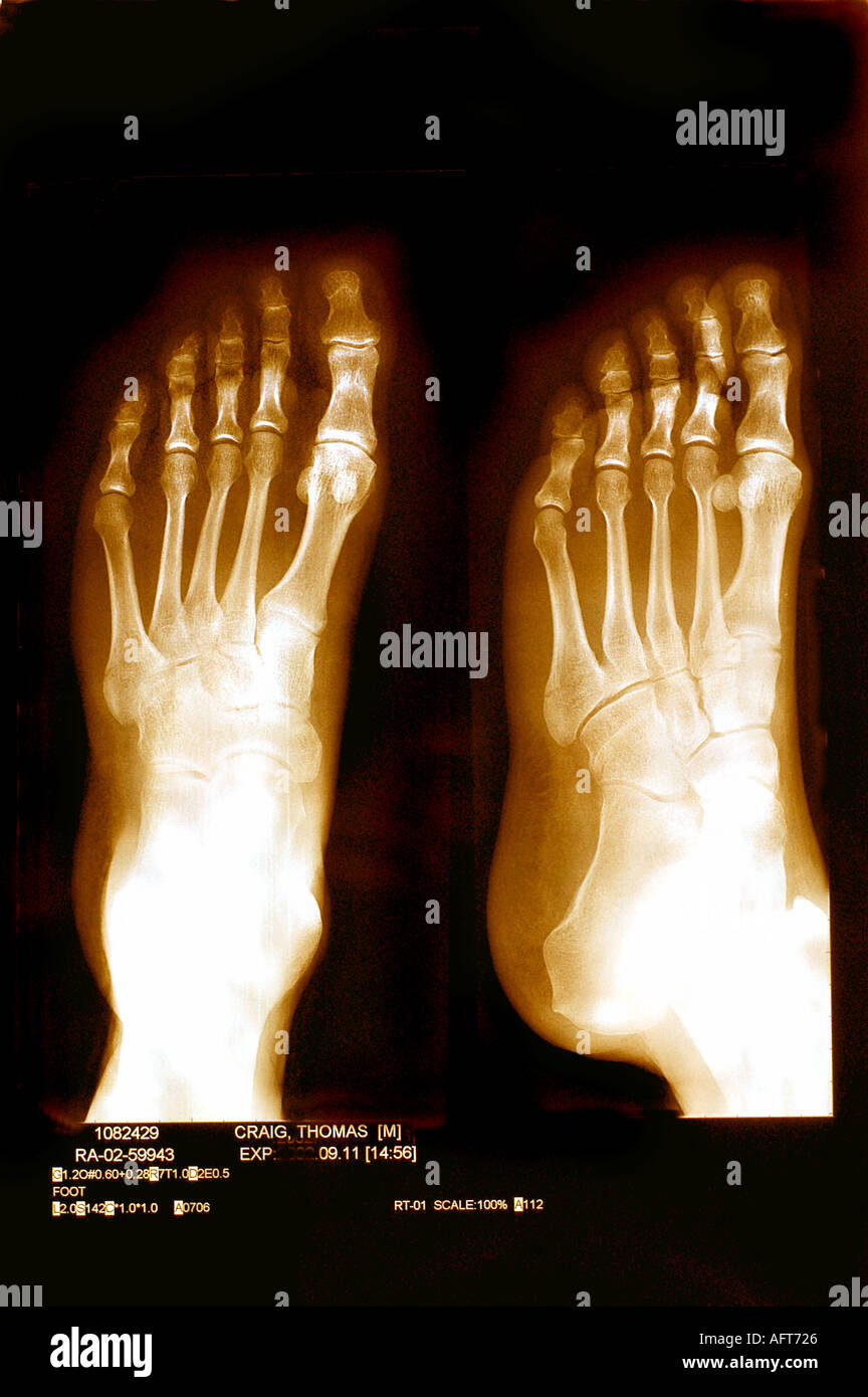 Medizinischen Röntgenstrahlen Bilder von gebrochenen Knochen im linken Fuß Gesundheit Care'Sepia Ton Stockfoto