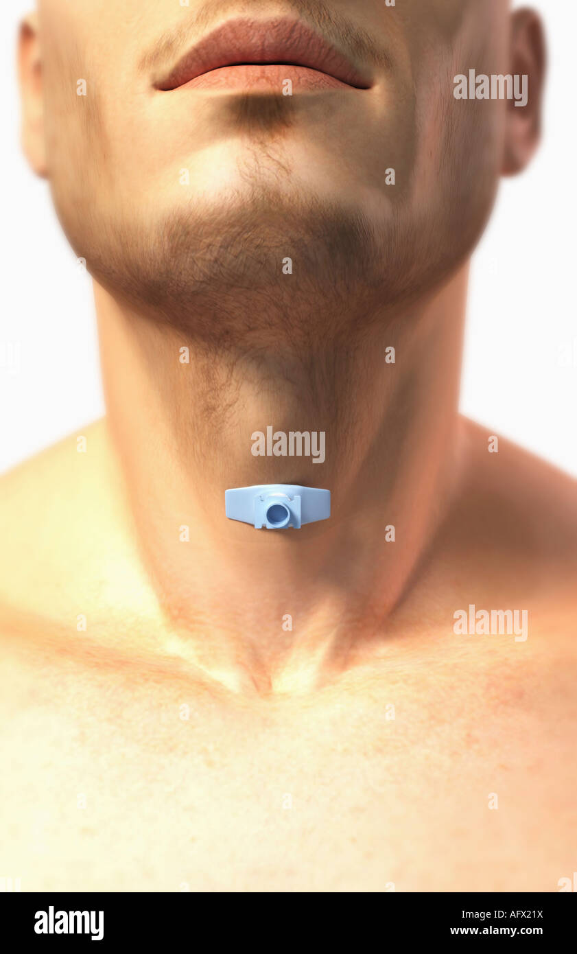 Tracheotomie Stockfotografie Alamy