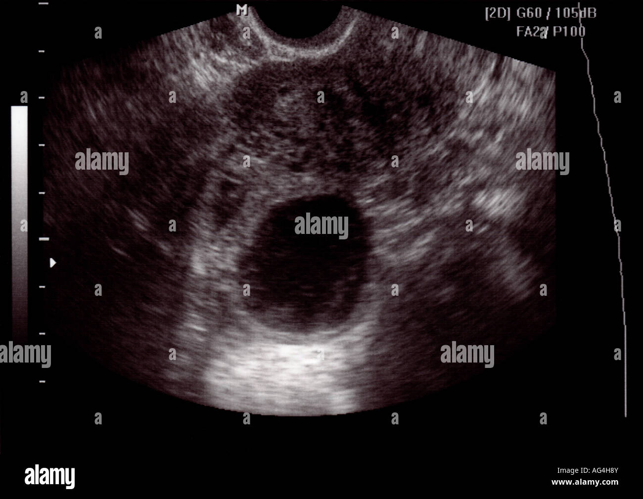 Vaginalen Ultraschall zeigt eine Ovarialzyste Stockfotografie Alamy