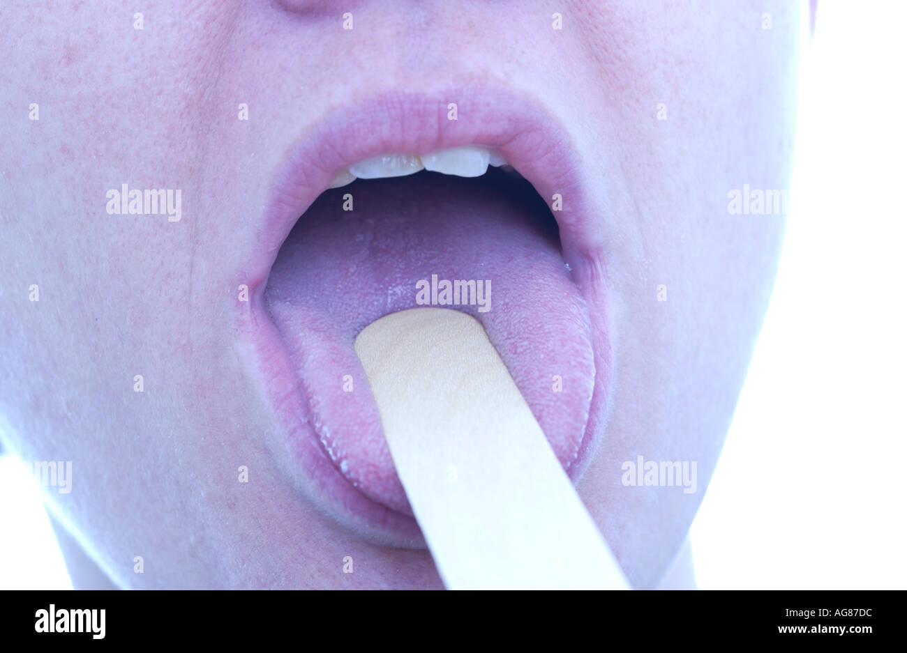 Nahaufnahme eines Kranken Mund mit Zunge depressor Stockfoto