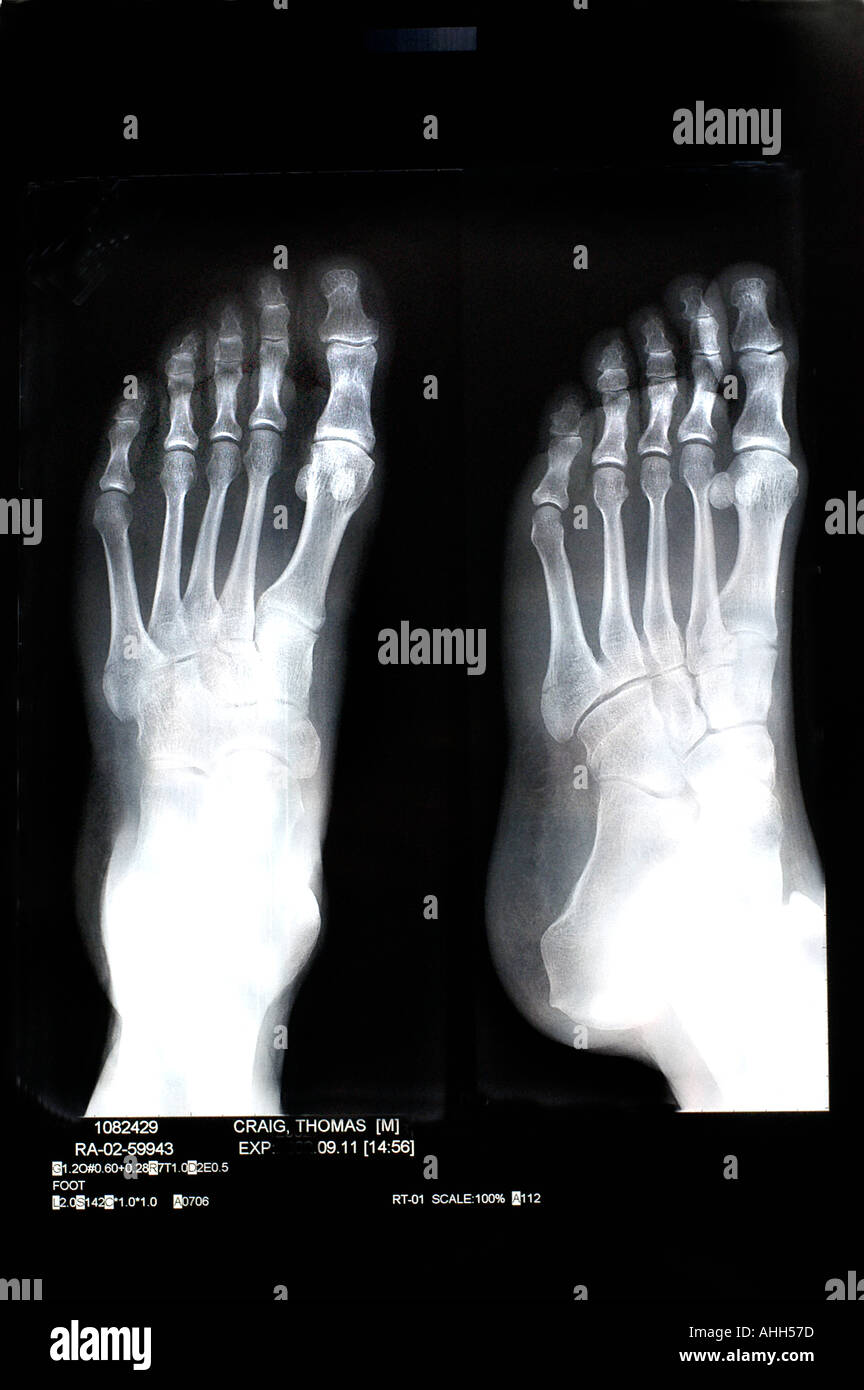 Medizinische Röntgenstrahlen von gebrochenen Knochen in „linker Fuß“-Röntgenbild „Schwarz und Weiß“ S/W „bis zum Leben“ Stockfoto