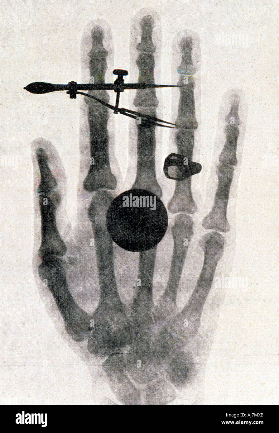 Wilhelm Röntgen Röntgenaufnahme der Hand seiner Frau, 1896. Artist: Wilhelm Conrad Rontgen Stockfoto