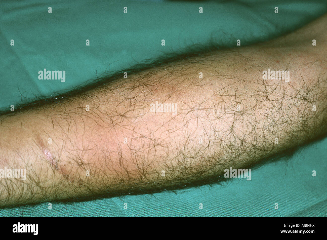 Ein Kompartmentsyndrom am Unterarm; für Fasziotomie Stockfoto