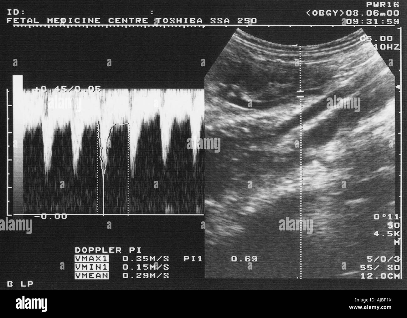 ULTRASCHALLUNTERSUCHUNG DER UTERINEN ARTERIE DOPPLER Stockfoto