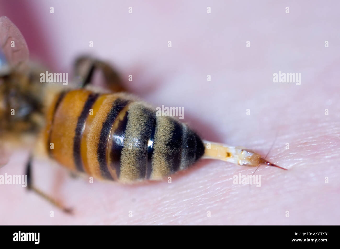 Nahaufnahme von Biene stechen Person.  Bienenstich ist aus Insekten Leiche nach stechen und die Biene stirbt gezogen. Stockfoto
