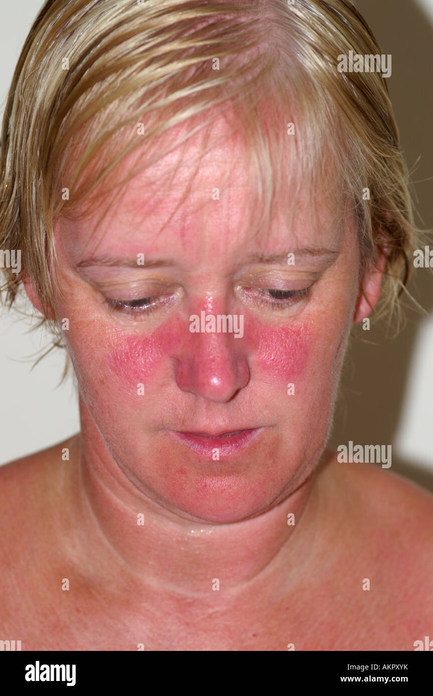 Fe-Male mit sonnenverbrannten Gesicht Stockfoto