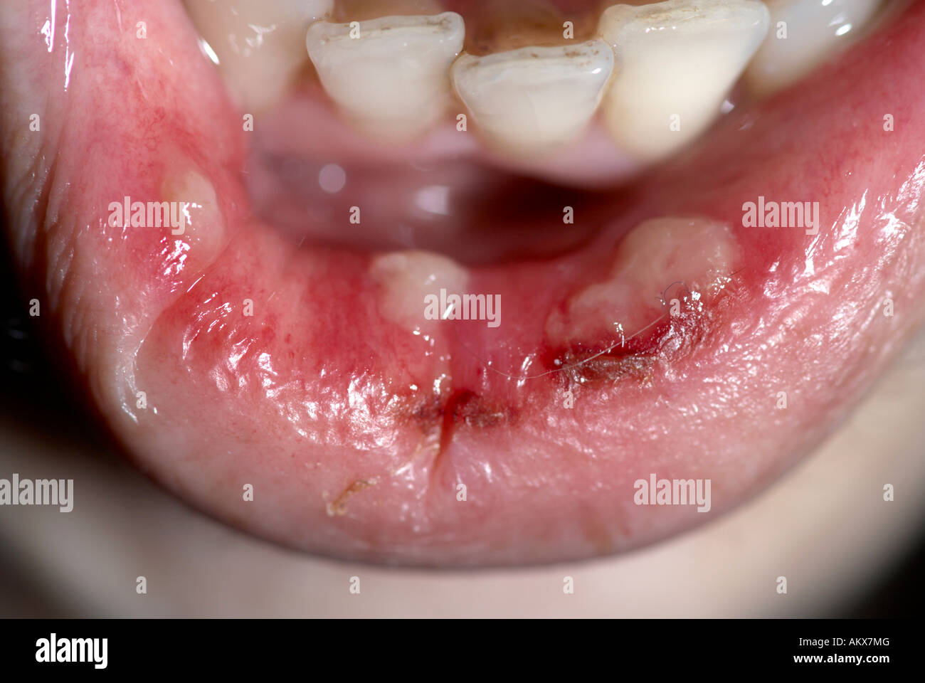 Lippenkrebs Stockfotos und bilder Kaufen Alamy