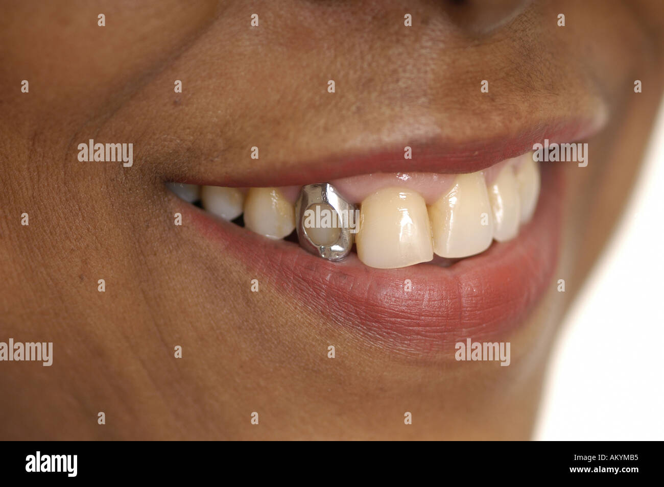Lacheln Sie Zahne Goldzahn Gold Zahnmedizin Gap Furnier Grinsen Stockfotografie Alamy