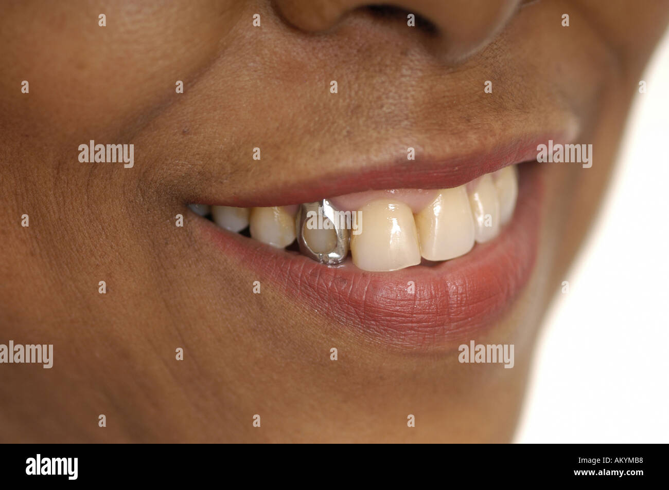 Zahngold -Fotos und -Bildmaterial in hoher Auflösung – Alamy