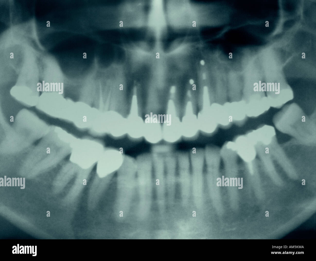 Dental Xray Röntgenfilm zeigt Reihen von traditionellen Amalgamfüllungen und Kappen. Stockfoto