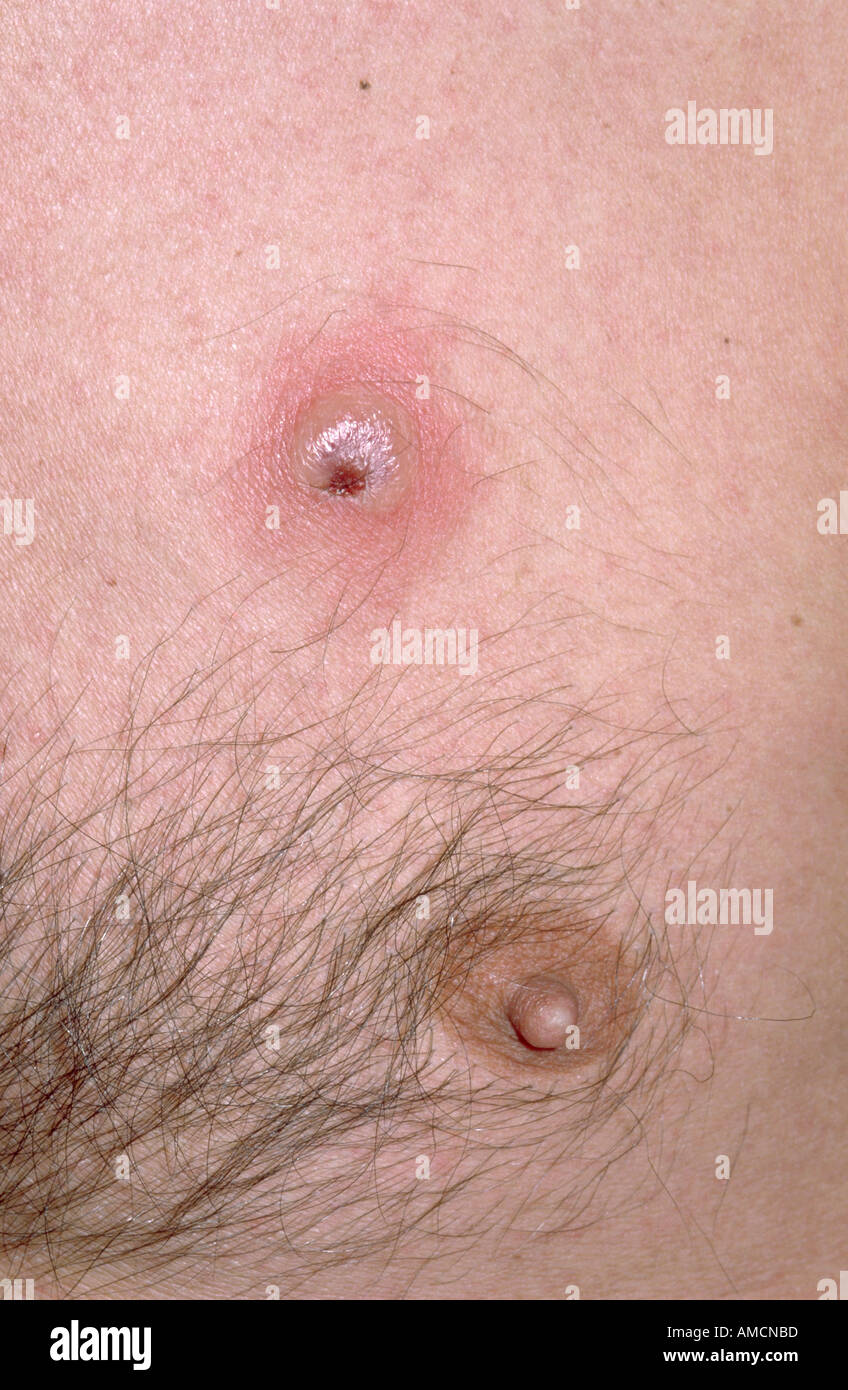 Kutane Lymphome Stockfoto, Bild 4969916 Alamy