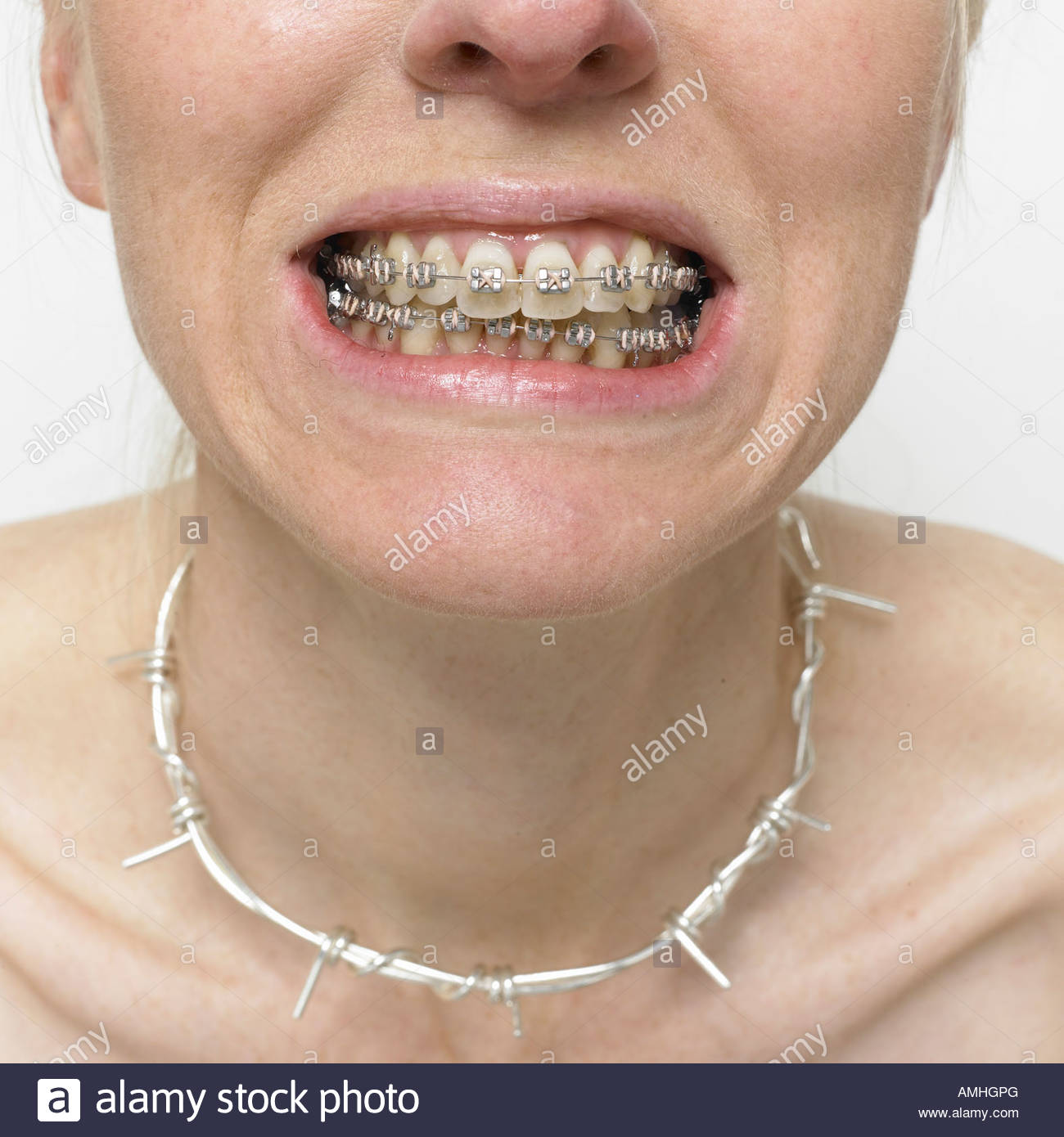 Orthodontic Appliance Stockfotos und bilder Kaufen Alamy