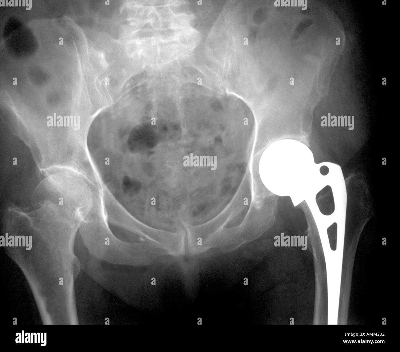 X Ray linke Hüfte mit Prothese rechten Hüfte gebrochen Stockfotografie