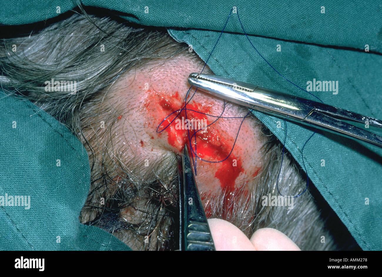 Nähen der Kopfhaut Platzwunde in örtlicher Betäubung Stockfoto