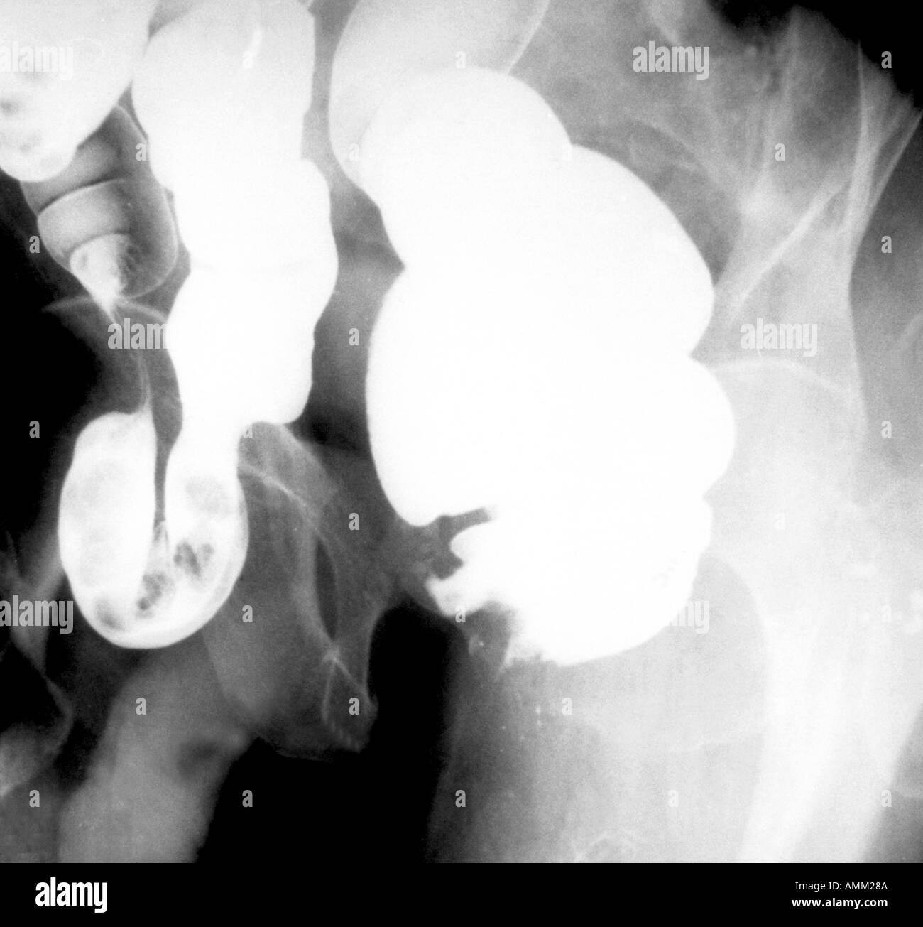 X-Ray akuten Pankreatitis gasless Bauch Stockfoto