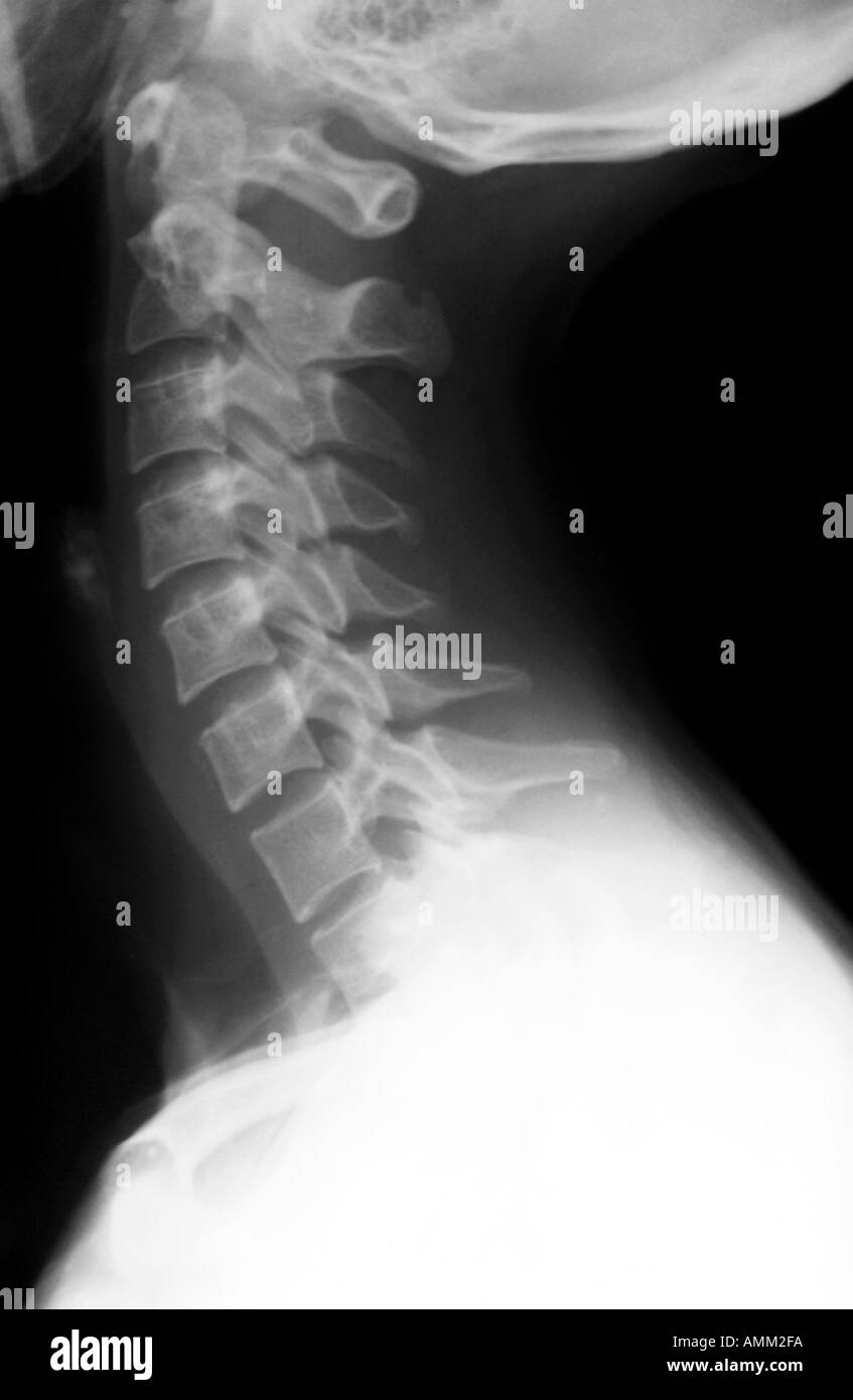 X-Ray normal Halswirbelsäule Stockfoto