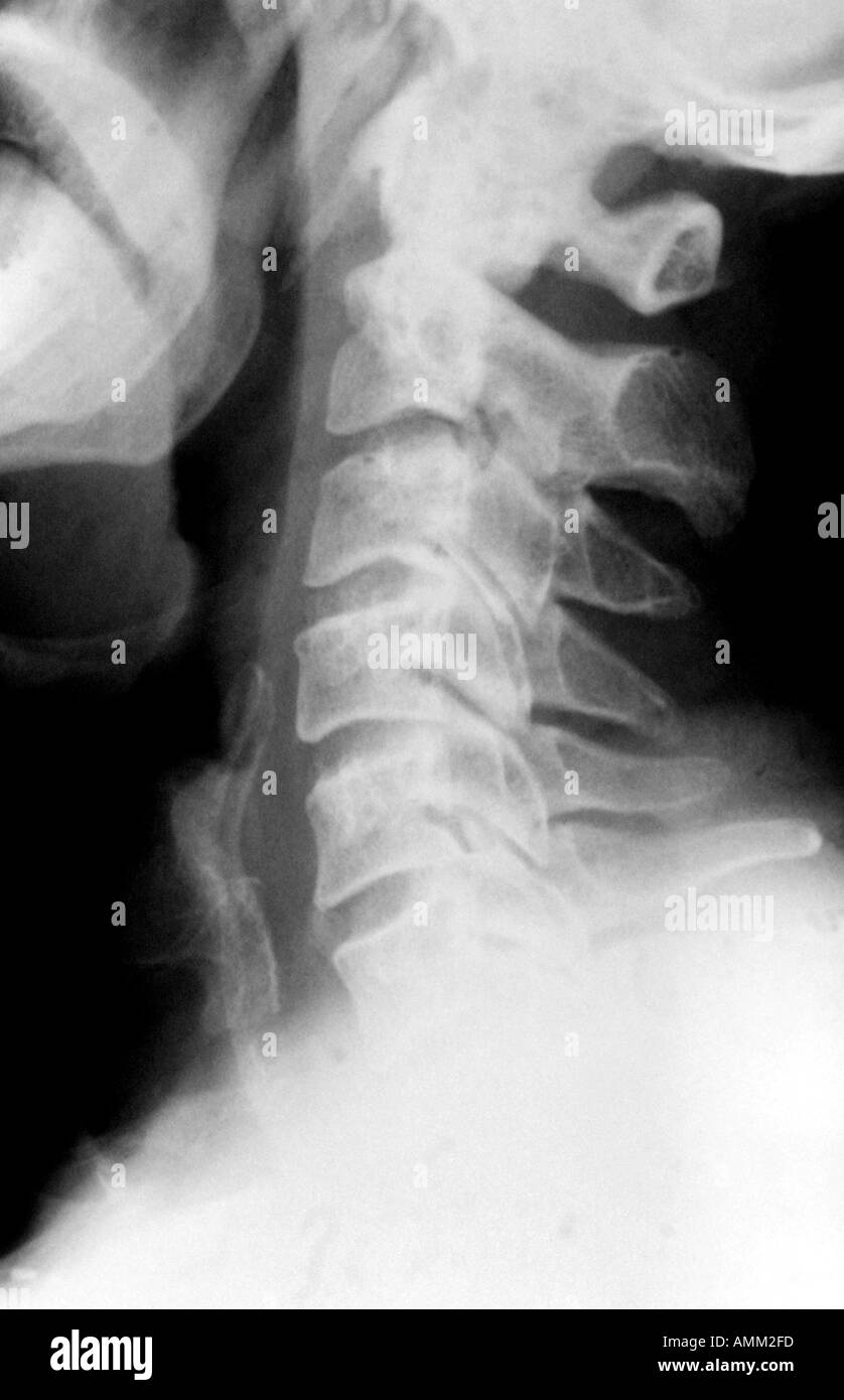 X-Ray normal Hals Stockfoto