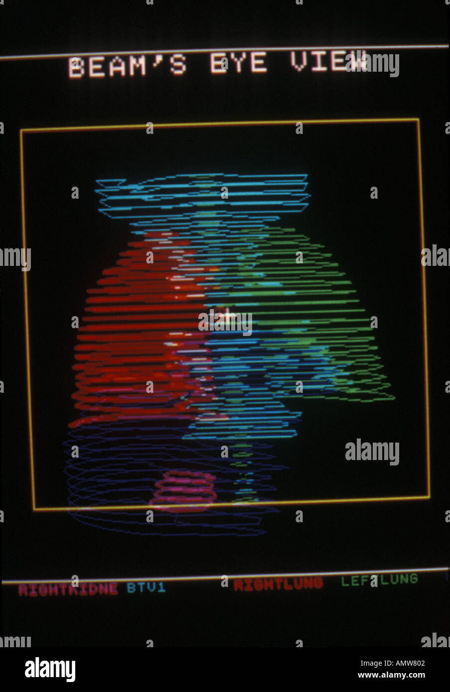3D Balken imaging Lunge Lunge Krebs pt für Strahlentherapie Stockfoto