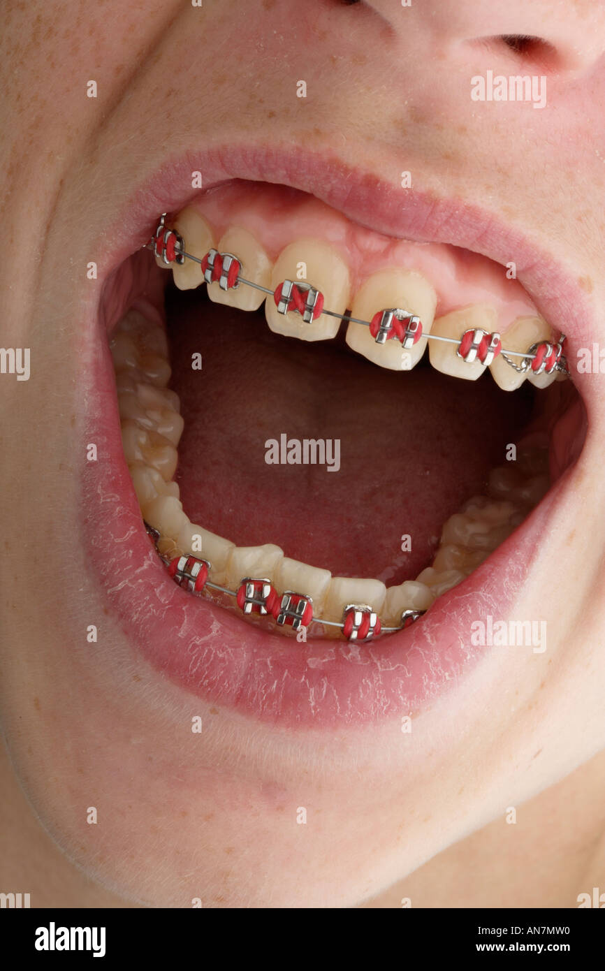 Othodontistry auf Kinder Zähne eine Klammer oder Halter Stockfoto