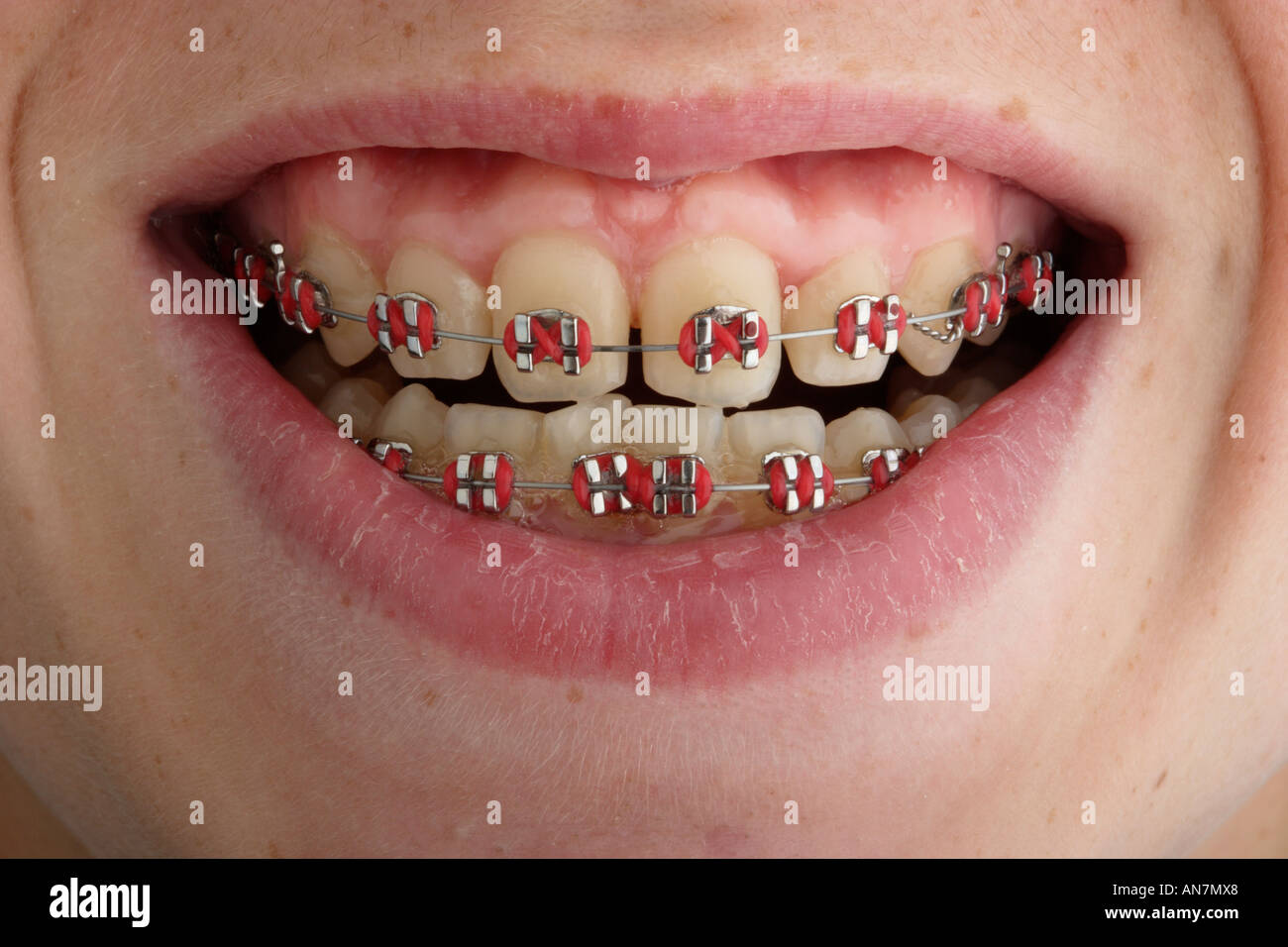 Othodontistry auf Kinder Zähne eine Klammer oder Halter Stockfoto