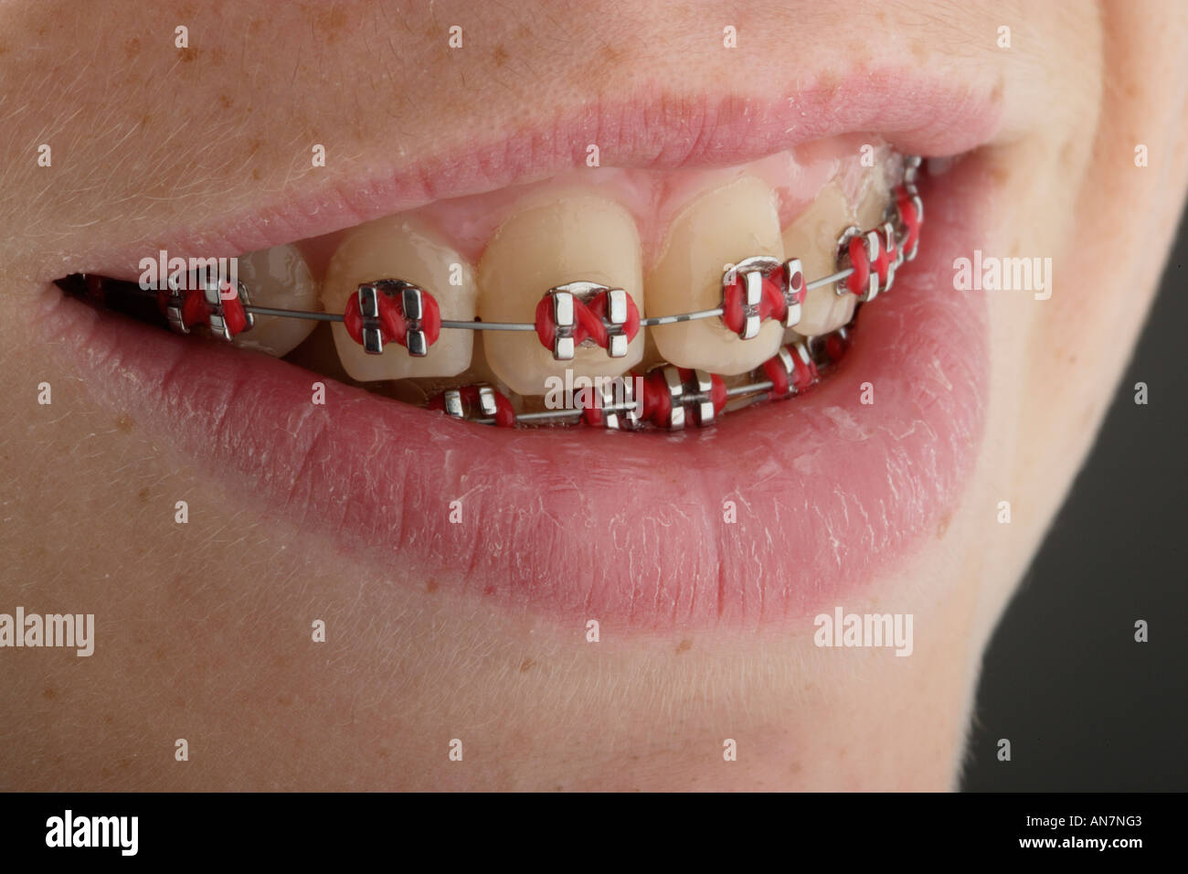 Orthodontistry auf den Zähnen des Kindes. Eine Klammer oder Halter Stockfoto