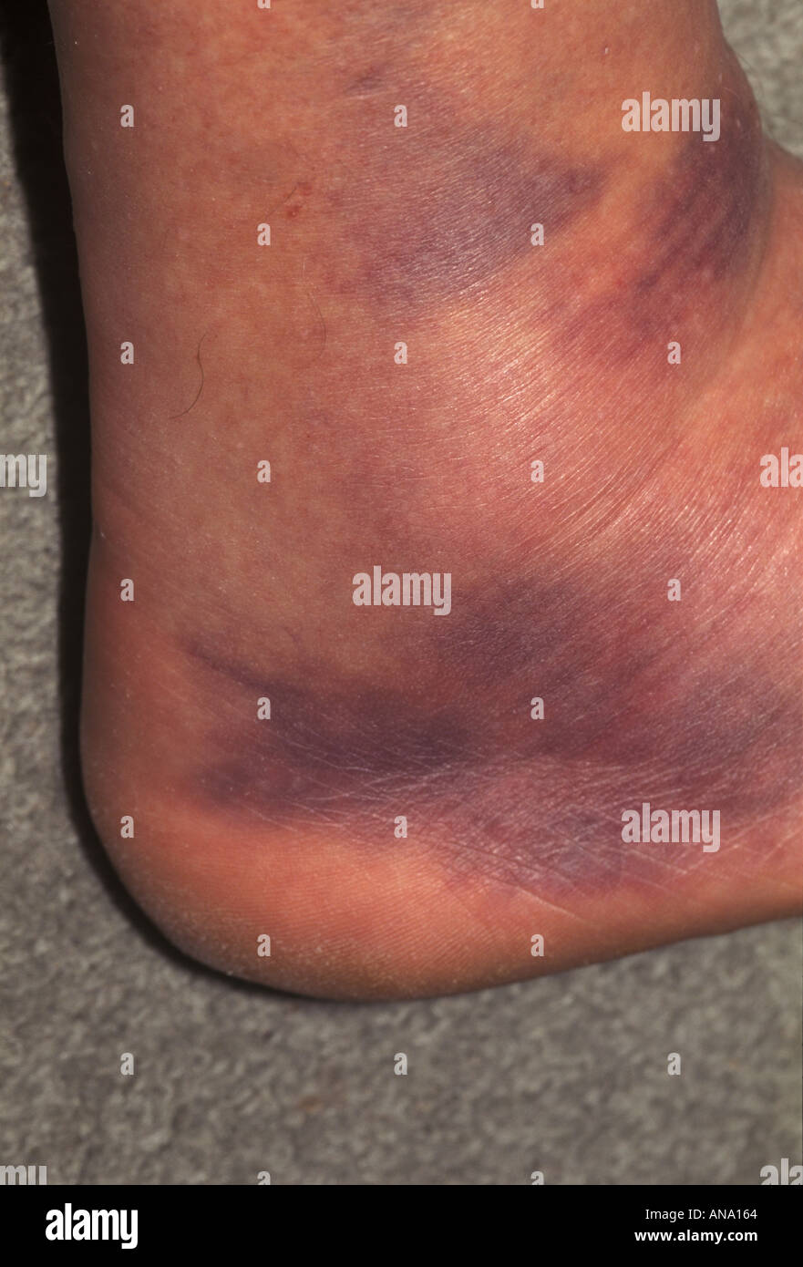 Ein gequetscht und verfärbte Knöchel verursacht durch Sturz von einem Pedal Fahrrad Stockfoto