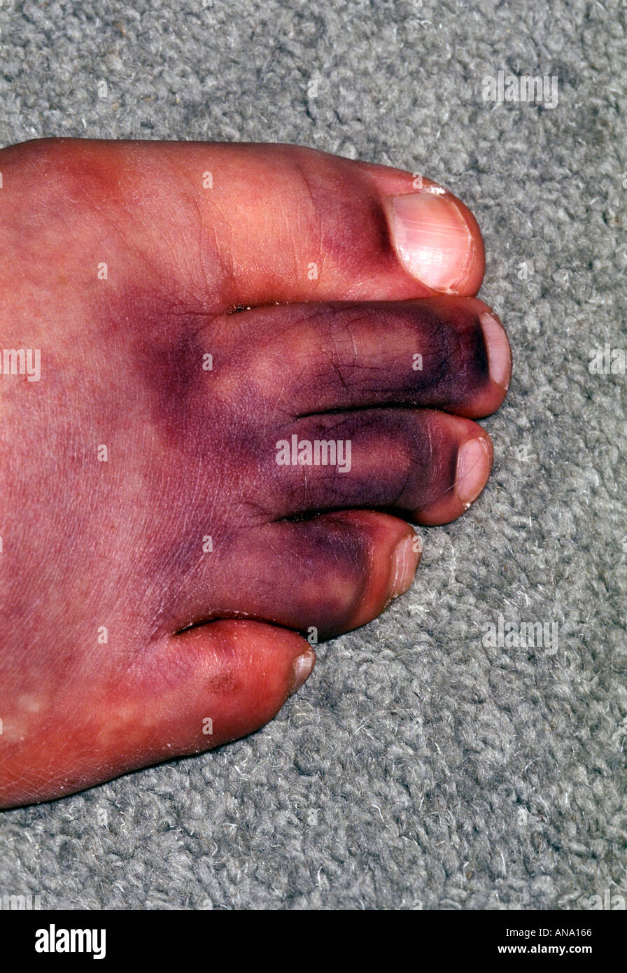 Verletzter Zehen verfärbt Stockfoto
