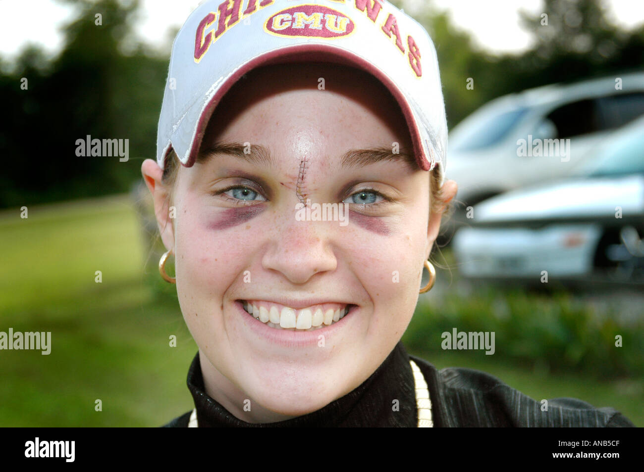 Verletzten weiblichen Teen mit schwarzen Augen und Stiche infolge von einem Pferd in den Kopf getreten Stockfoto