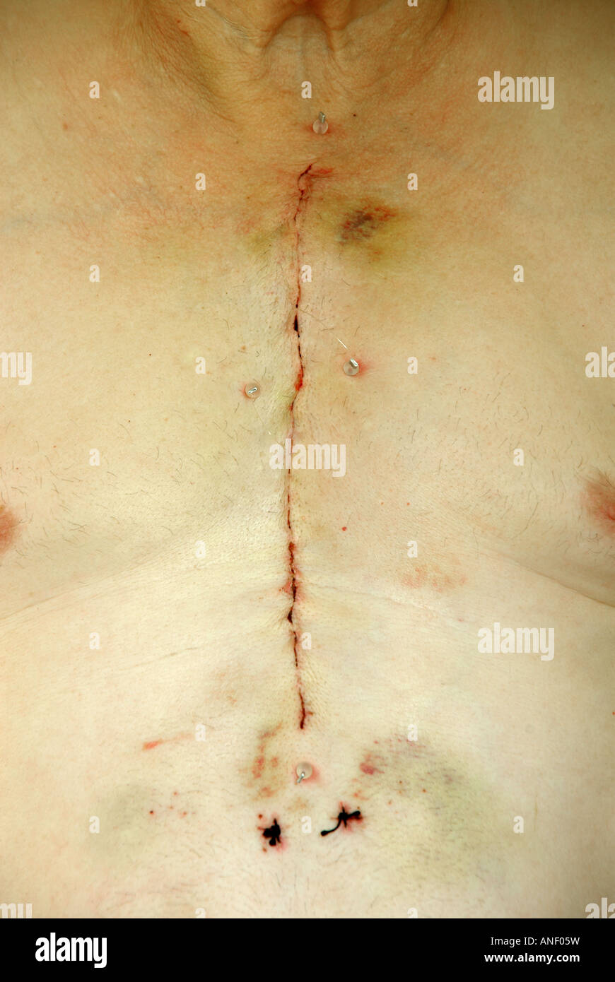 Narbe Patient Brust Wunde Operation Stockfotos Und Bilder Kaufen Alamy