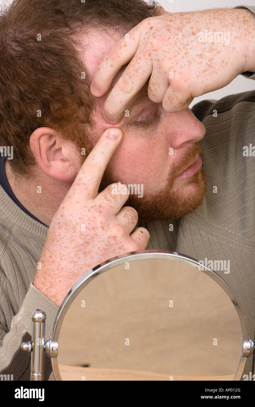 Ein Mann, der einen Fleck drückt und whitehead auf sein Gesicht drückt Stockfoto