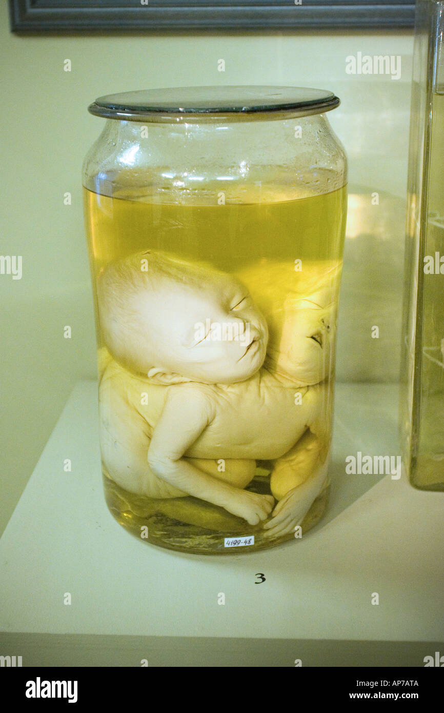 Erhaltene ungeborenes Baby in den Jar an der Peter der Große Museum für Anthropologie und Ethnographie St. Petersburg Stockfoto