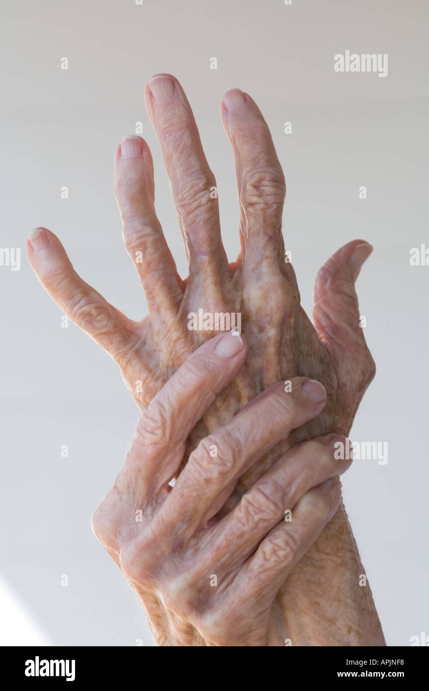 arthritischen Händen einer alten Frau Stockfoto