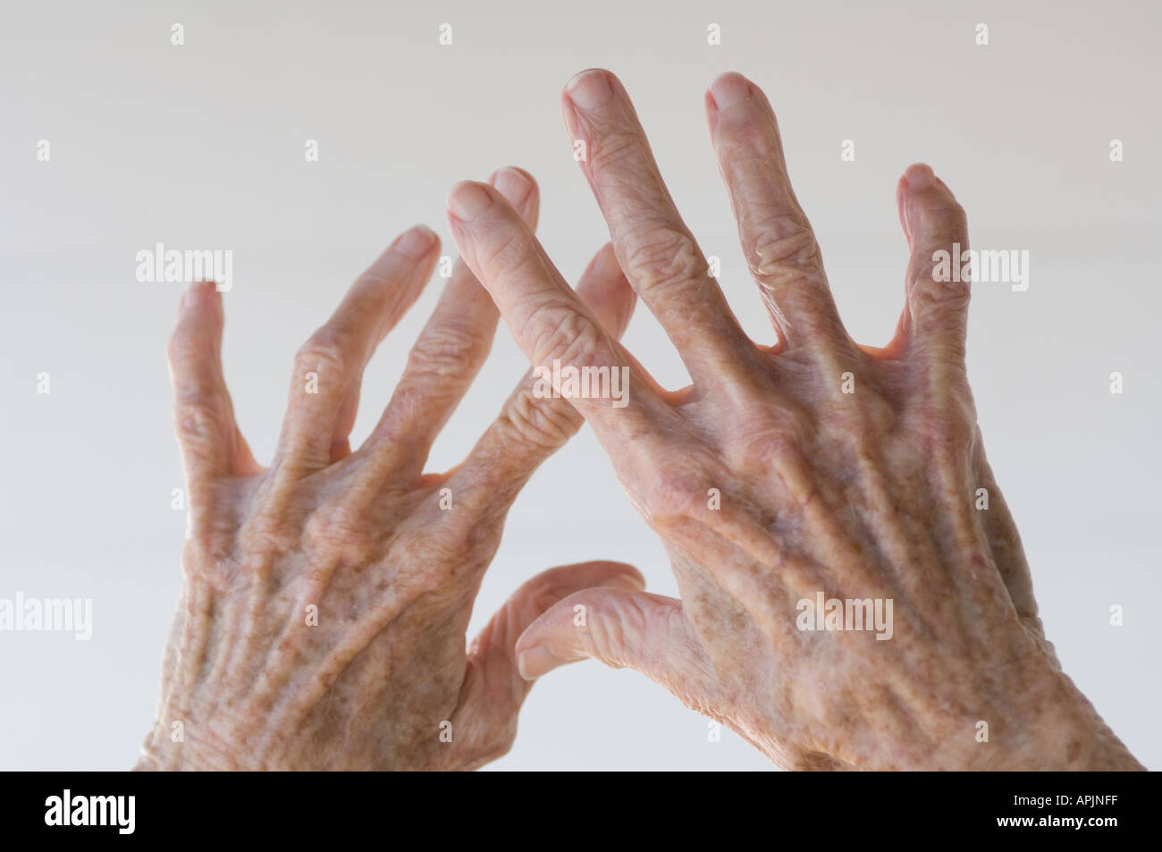 arthritischen Händen einer alten Frau Stockfoto
