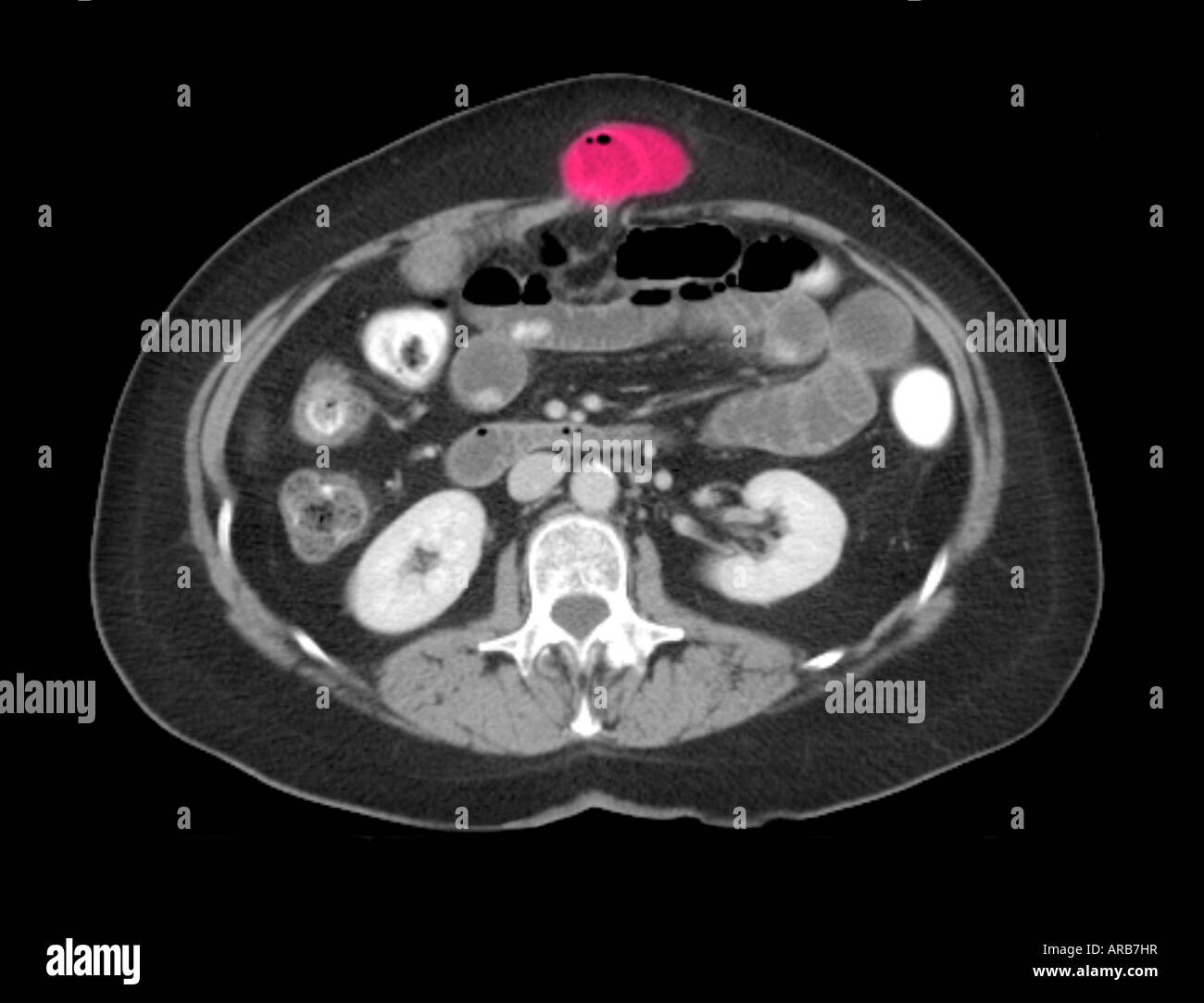 CT-Scan axiale Ansicht eine Hernie der Bauchwand Stockfotografie - Alamy