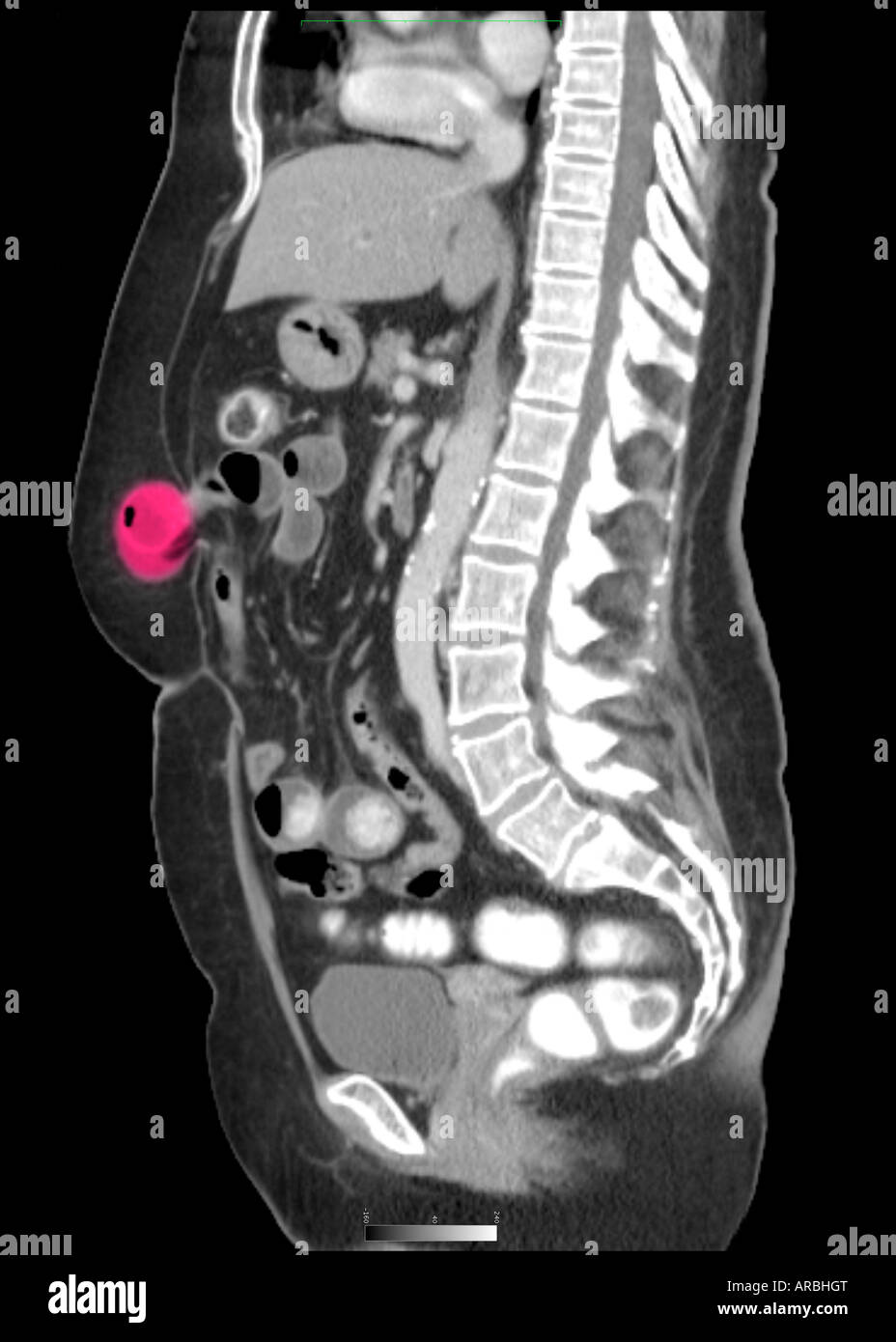 CT-Scan sagittaler Ansicht eine Hernie der Bauchwand Stockfotografie