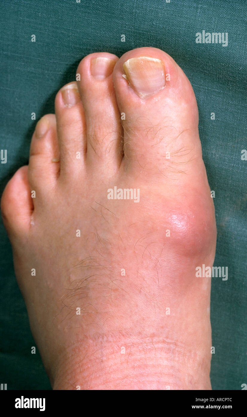 Fuß geschwollen gicht Gichtanfall: Symptom,