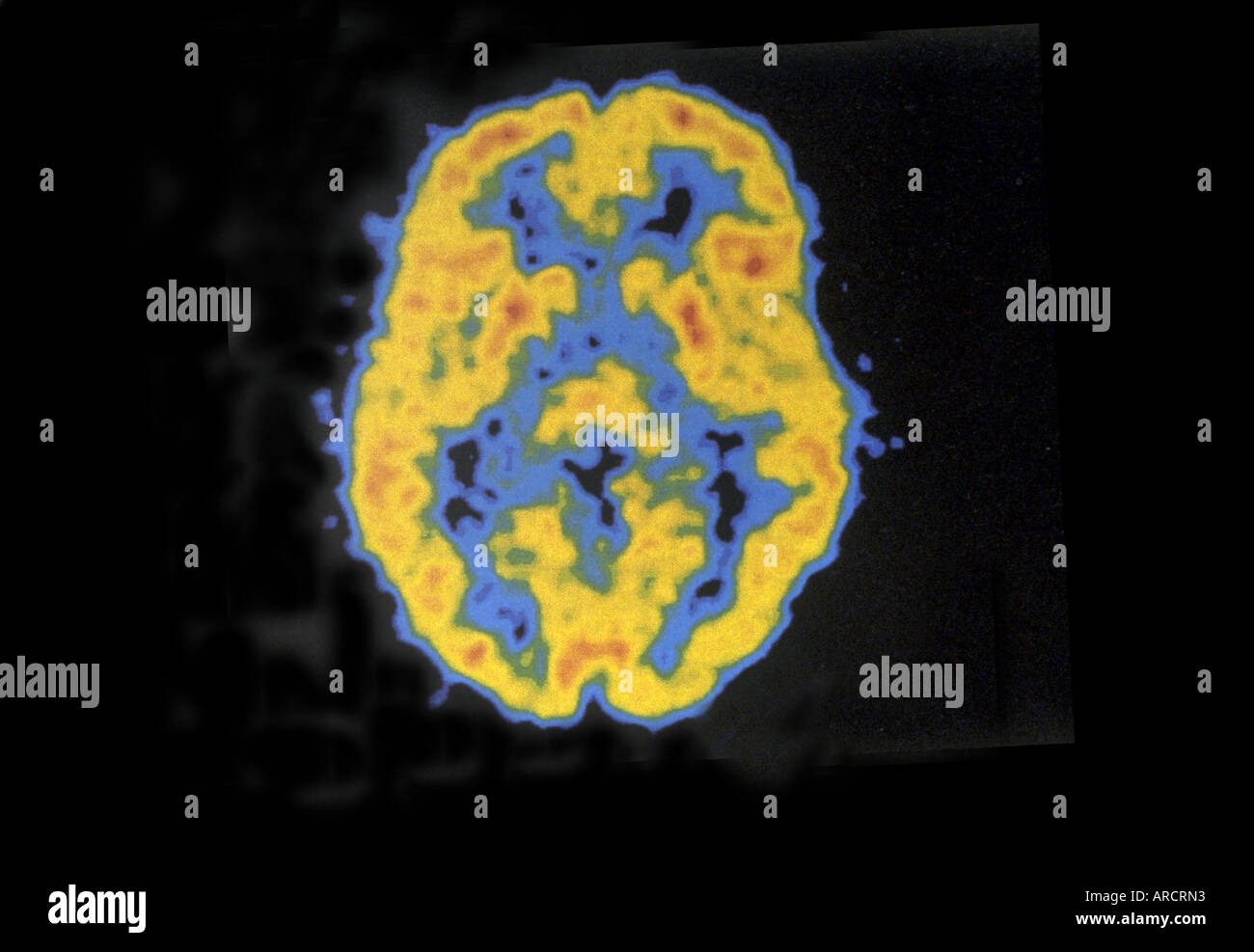 Ein normaler Positronen-Emissions-Tomographie (PET)-Scan des Gehirns. Stockfoto