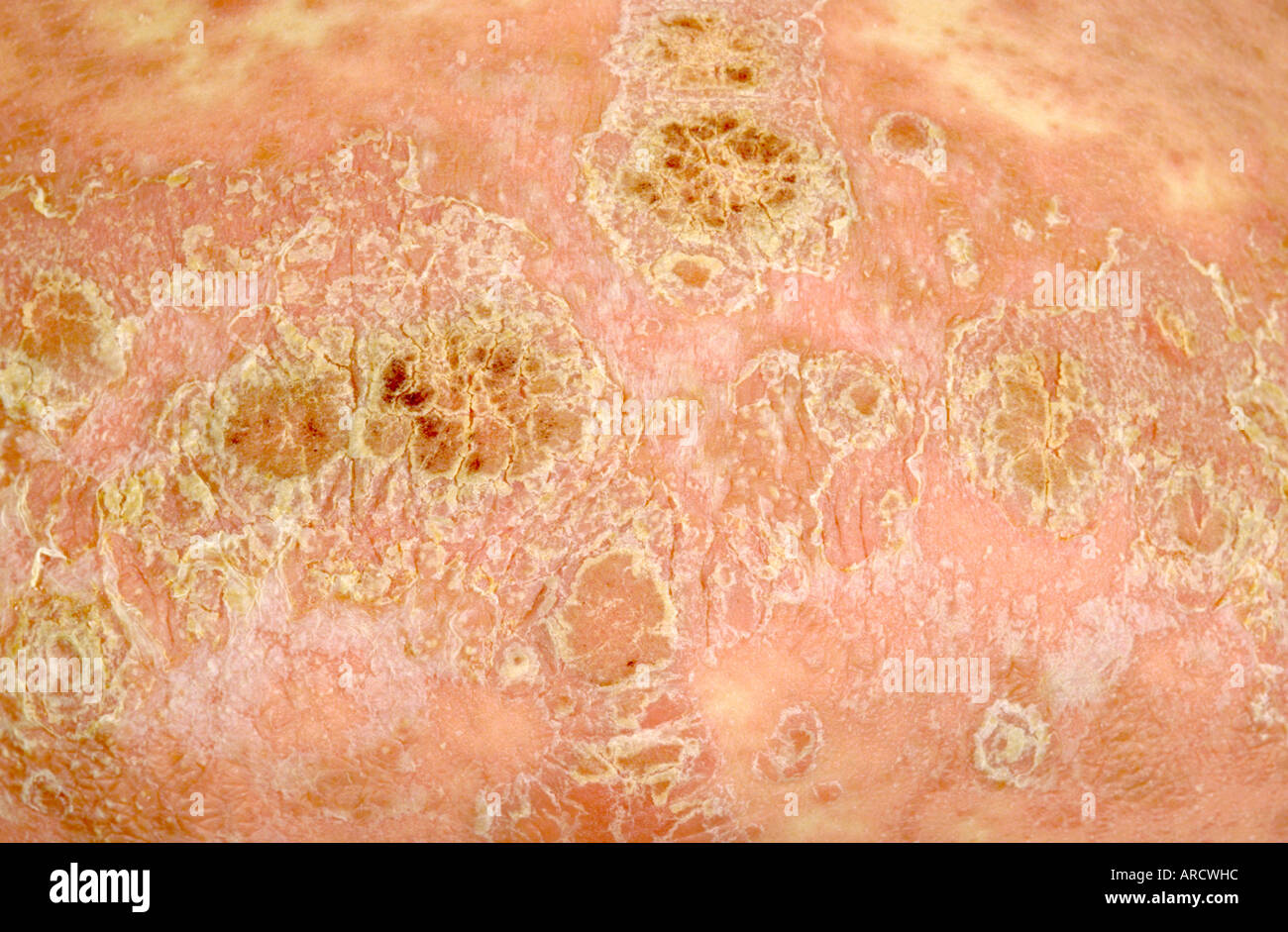 Nahaufnahme Foto der Plaque-Psoriasis, eine häufige entzündliche Hautkrankheit. Stockfoto